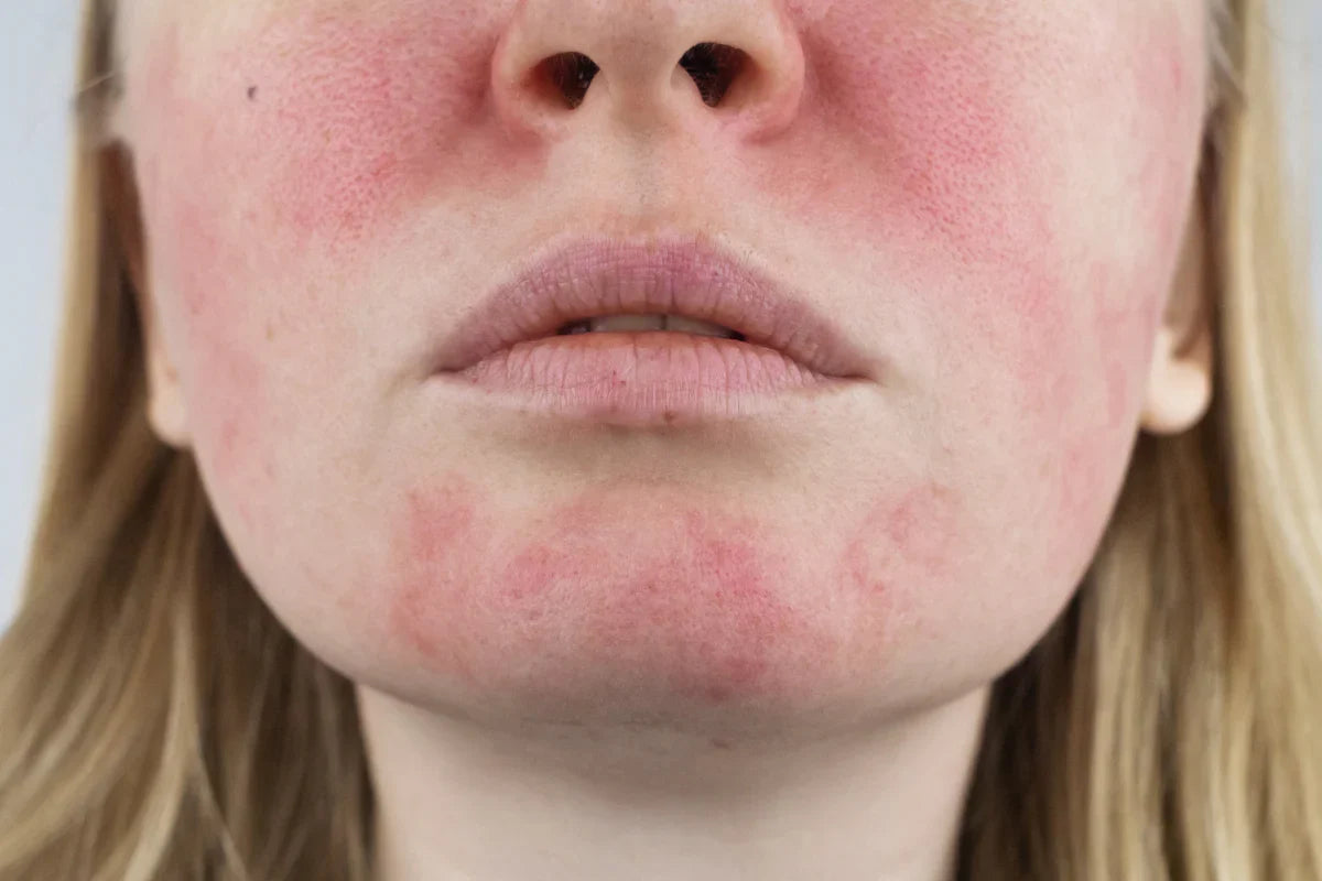 Pele vermelha e irritada? O problema pode estar nos seus produtos de skincare